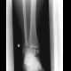 Bimalleolar ankle fracture: X-ray - Plain radiograph